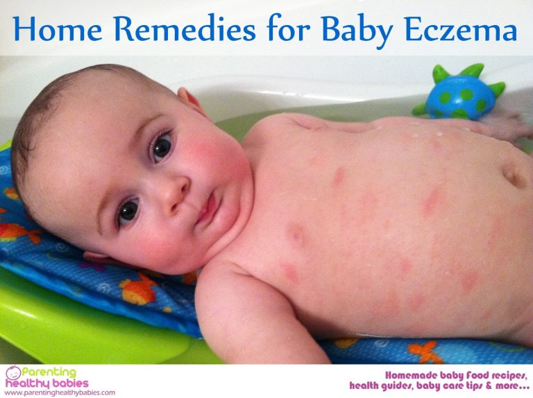 Home Remedies For Baby Eczema