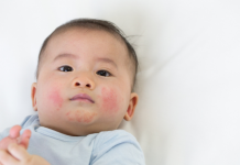 Baby Eczema Home Remedies