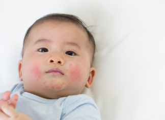 Baby Eczema Home Remedies