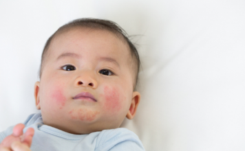 Baby Eczema Home Remedies