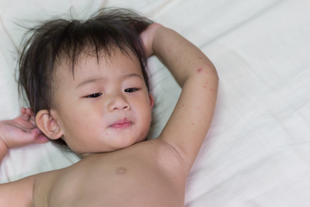 Hand Foot And Mouth Disease In Kids