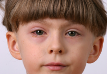 remedies for conjunctivitis