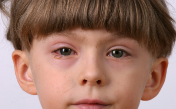 remedies for conjunctivitis