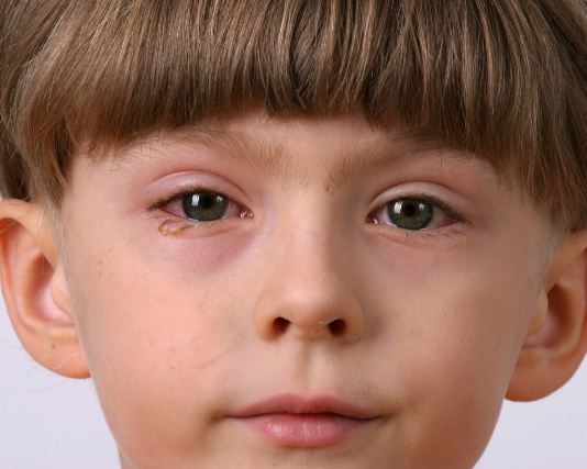 remedies for conjunctivitis