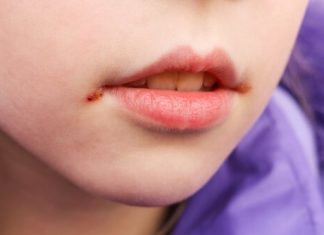 mouth ulcers in children