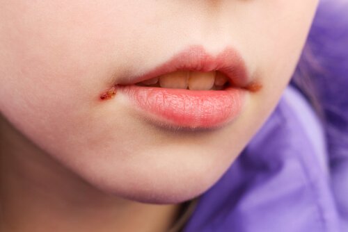 mouth ulcers in children
