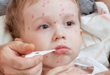 Summer Diseases in Children