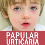 Papular Urticaria: Signs and Symptoms and Treatment