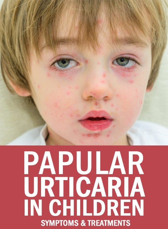 Papular Urticaria: Signs and Symptoms and Treatment