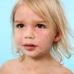 papular rash child