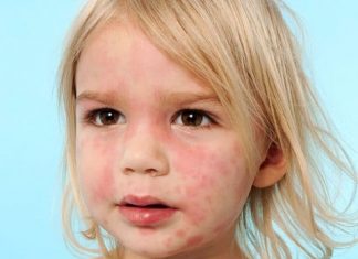 papular rash child