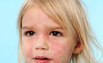 papular rash child