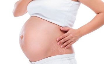home remedy for stretch marks