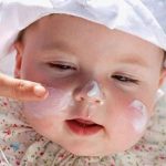 treatment for baby acne