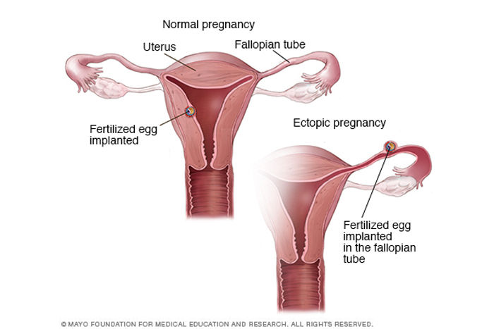 ectopic-pregnancy vs nomal pregnancy