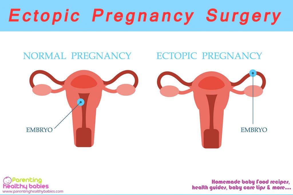 Ectopic Surgery and Recovery