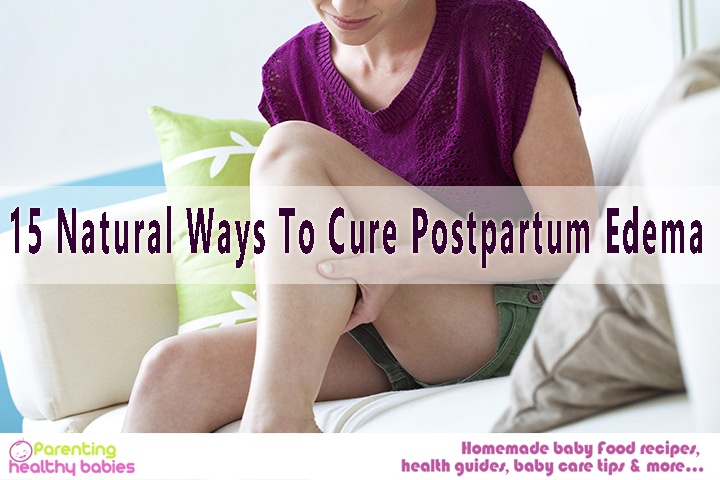 postpartum edema