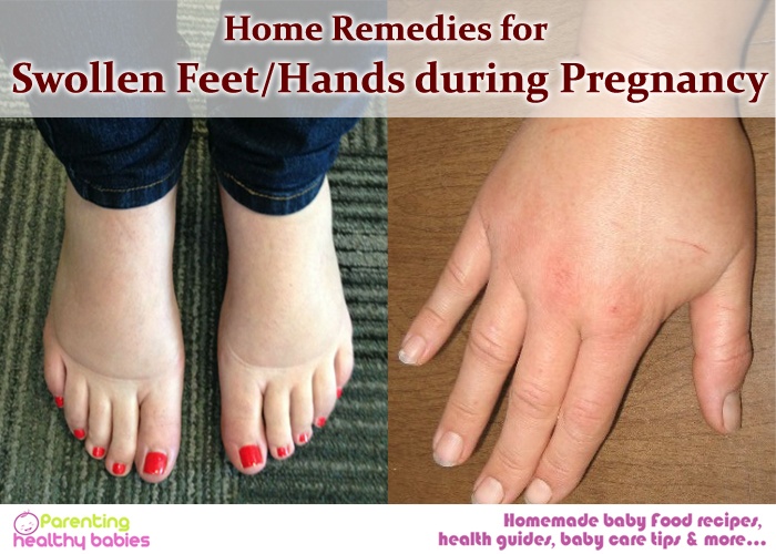 swollen feet during pregnancy remedies, swollen hands during pregnancy remedies, swollen feet during pregnancy treatment