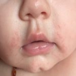 Natural Ways to Treat Drool Rash in Babies