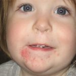 Impetigo in Babies: Signs and Symptoms