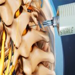 5 long-term side effects of epidural
