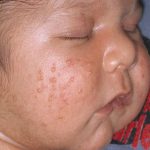 Home Remedies to Treat Milia in Babies