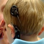 Must know Benefits of Cochlear Implants in Infants