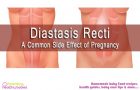 Diastasis Recti- A Common Side Effect of Pregnancy