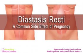 Diastasis Recti- A Common Side Effect Of Pregnancy