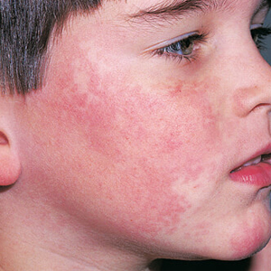 7 Home Remedies To Treat ‘fifth Disease’ In Children