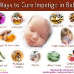 11 Natural ways of treating Impetigo in babies