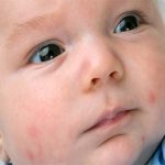 11 Natural ways of treating Impetigo in babies