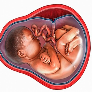 what happens when amniotic fluid is low what happens when amniotic fluid is low