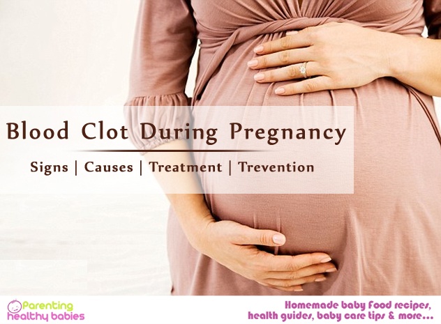 Blood Clot During Pregnancy Signs Causes Treatment Prevention