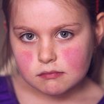 Symptoms and Causes of Fifth disease in children