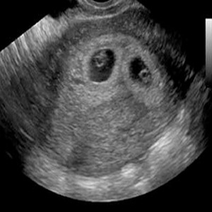 Week 5 of pregnancy: Pregnancy week by week