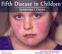 Symptoms and Causes of Fifth Disease in Children