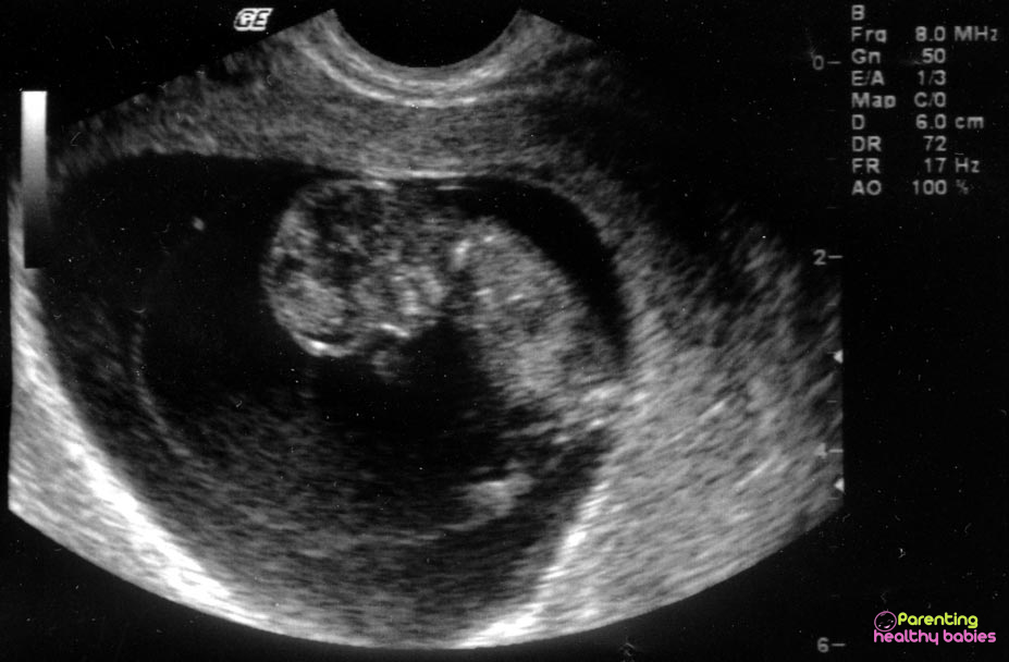 week 10 ultrasound