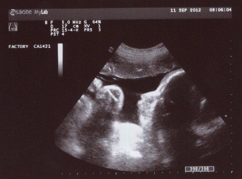 34 weeks pregnancy ultrasound