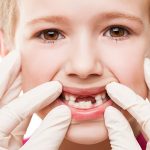 Cavities in Baby Teeth: Ultimate guide – Causes, Symptoms, Treatment