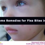 Flea Bites: 11 Effective Home Remedies for Kids