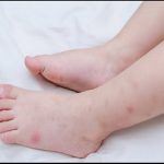 Flea Bites: 11 Effective Home Remedies for Kids