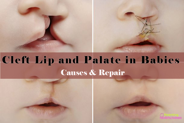 cleft lip and palate in babies