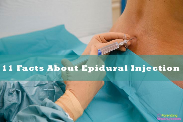 epidural injection facts