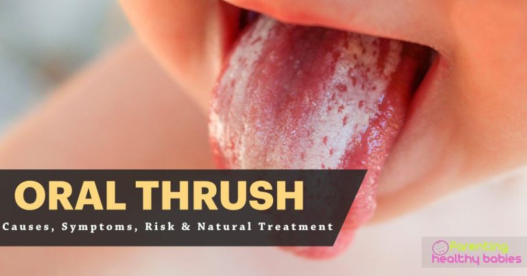Oral Thrush- Causes, Symptoms, Risk & Natural Treatment