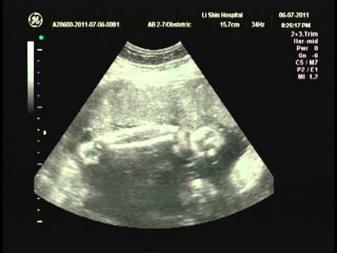week 33 ultrasound
