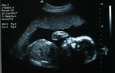 week 24 pregnancy ultrasound