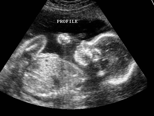week 38 pregnancy ultrasound