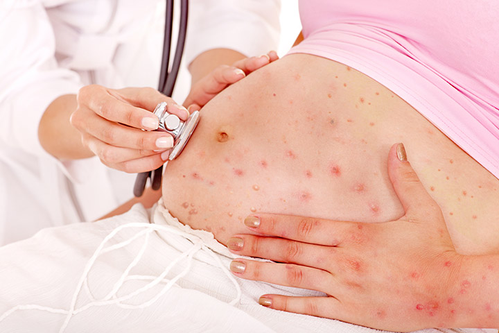 Chickenpox during Pregnancy