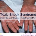 Toxic Shock Syndrome: Symptoms, Signs, Causes, Treatment And Prevention